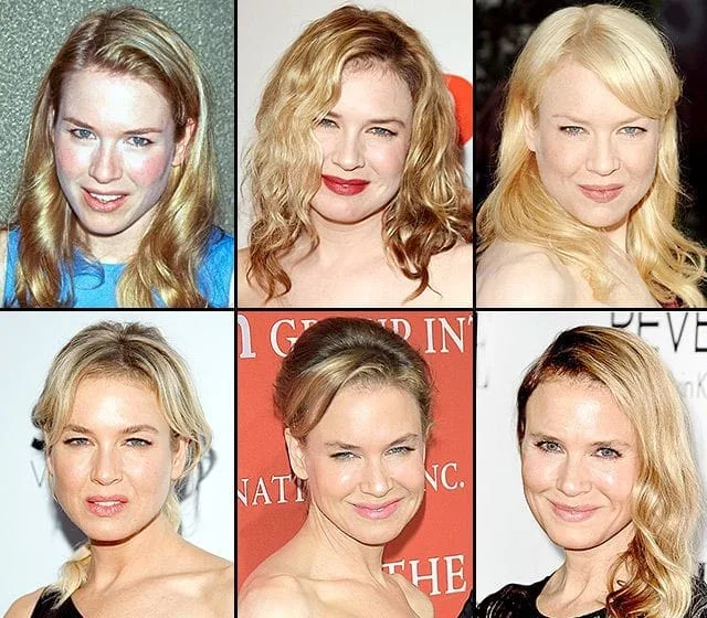 Exploring Renee Zellwegers Plastic Surgery Journey: Before and After Photos