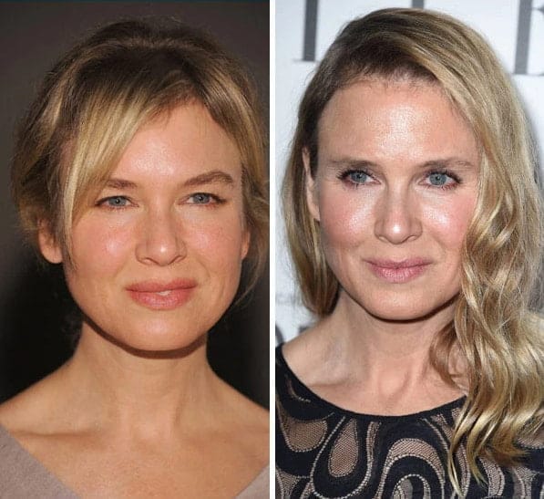 Exploring Renee Zellwegers Plastic Surgery Journey: Before and After Photos