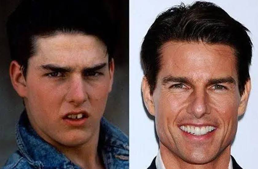 Surprising Photos of Tom Cruise Teeth Before Cosmetic Dentistry