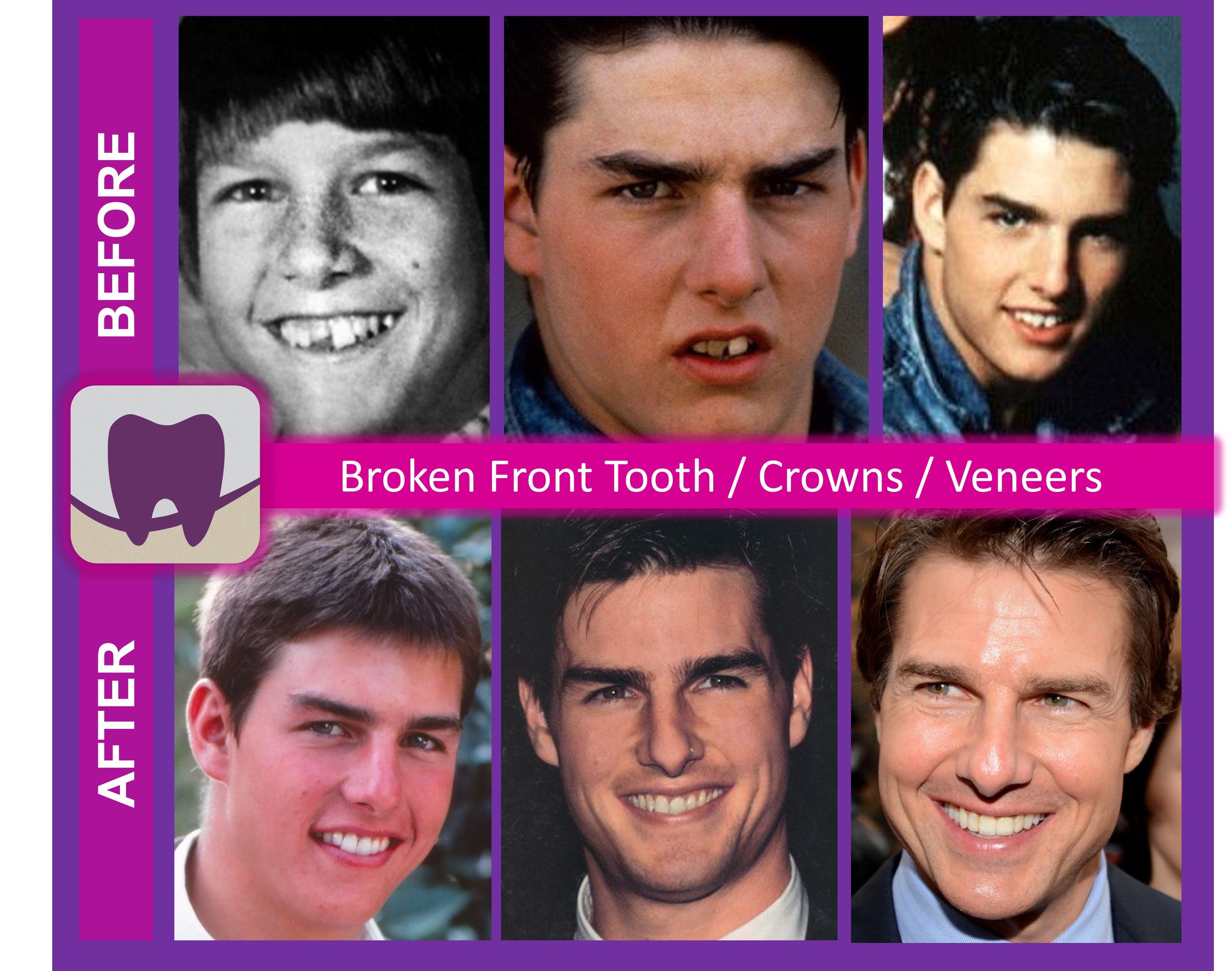 See How Tom Cruise Young Teeth Changed Over Time