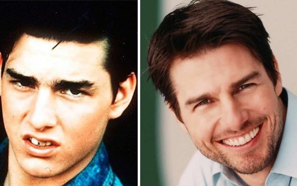 Surprising Photos of Tom Cruise Teeth Before Cosmetic Dentistry