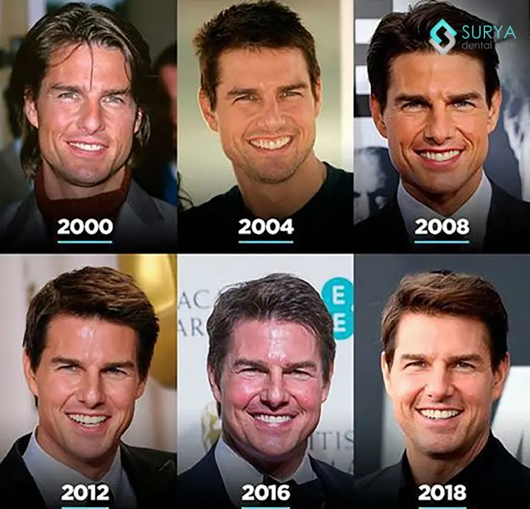 Tom Cruise Smile Transformation: The Complete Story You Need to Know
