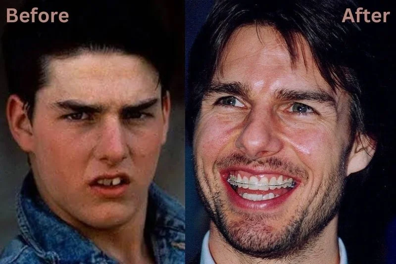 Tom Cruise Teeth Before and After: A Shocking Transformation