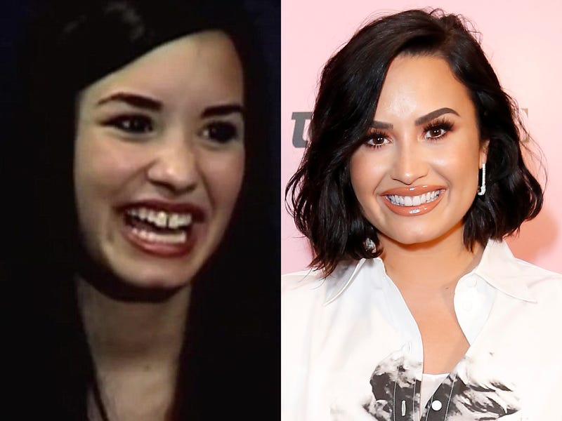 Before and After: Celebrities With Gap Teeth Transformations